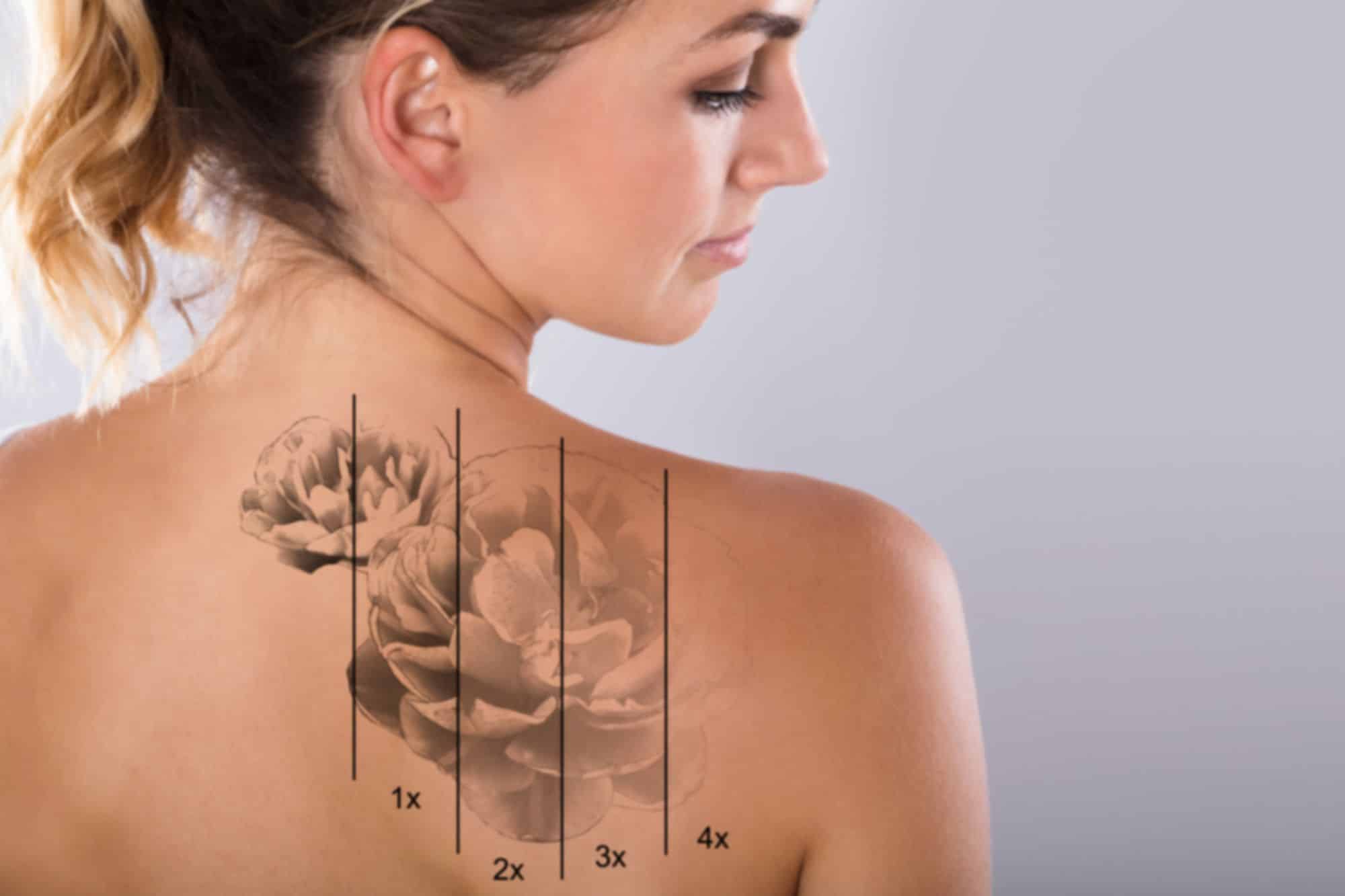 Tattoo Removal for Teenagers and Young Adults * tattoo-removal-for-teenagers-young-adults